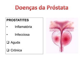 PROSTATITES
• Inflamatória
• Infecciosa
 Aguda
 Crônica
 