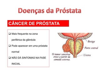 CÂNCER DE PRÓSTATA
 Mais frequente na zona
periférica da glândula
 Pode aparecer em uma próstata
normal
 NÃO DÁ SINTOMAS NA FASE
INICIAL
 