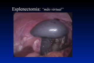 Esplenectomia:  “mão virtual”   