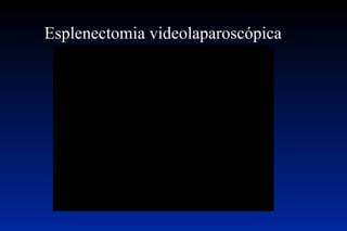 Esplenectomia videolaparoscópica   