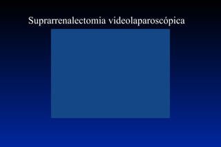 Suprarrenalectomia videolaparoscópica  Vídeo  
