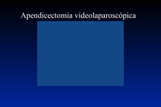 Apendicectomia videolaparoscópica  Vídeo  