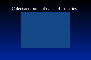 Vídeo  Colecistectomia clássica: 4 trocartes 