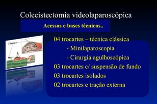 Colecistectomia videolaparoscópica  Acessos e bases técnicas.. 04 trocartes – técnica clássica  - Minilaparoscopia - Cirurgia agulhoscópica 03 trocartes c/ suspensão de fundo 03 trocartes isolados  02 trocartes e tração externa 