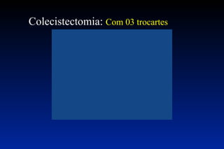 Colecistectomia:  Com 03 trocartes  Vídeo  