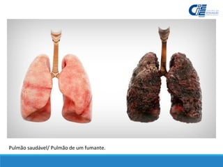 Pulmão saudável/ Pulmão de um fumante.
 