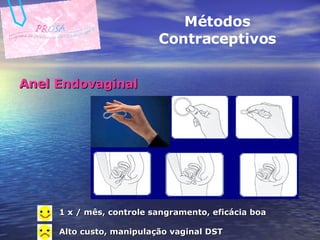 Anel Endovaginal Métodos Contraceptivos 1 x / mês, controle sangramento, eficácia boa Alto custo, manipulação vaginal DST 