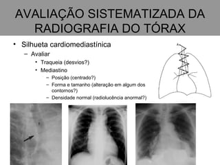 AVALIAÇÃO SISTEMATIZADA DA RADIOGRAFIA DO TÓRAX Silhueta cardiomediastínica Avaliar Traqueia (desvios?) Mediastino Posição (centrado?) Forma e tamanho (alteração em algum dos contornos?) Densidade normal (radiolucência anormal?) 