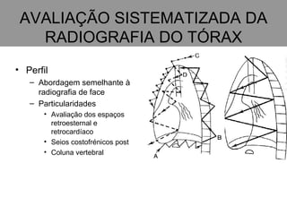 AVALIAÇÃO SISTEMATIZADA DA RADIOGRAFIA DO TÓRAX Perfil Abordagem semelhante à radiografia de face Particularidades Avaliação dos espaços retroesternal e retrocardíaco Seios costofrénicos post Coluna vertebral 