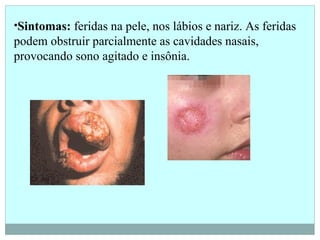 •Sintomas: feridas na pele, nos lábios e nariz. As feridas
podem obstruir parcialmente as cavidades nasais,
provocando sono agitado e insônia.
 