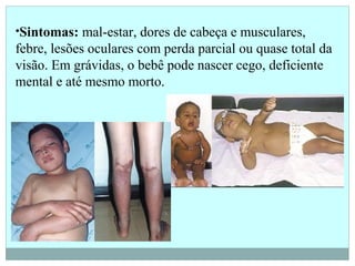 •Sintomas: mal-estar, dores de cabeça e musculares,
febre, lesões oculares com perda parcial ou quase total da
visão. Em grávidas, o bebê pode nascer cego, deficiente
mental e até mesmo morto.
 