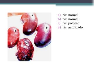 a) rim normal
b) rim normal
c) rim polposo
d) rim autolizado
 