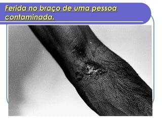 Ferida no braço de uma pessoa contaminada. 