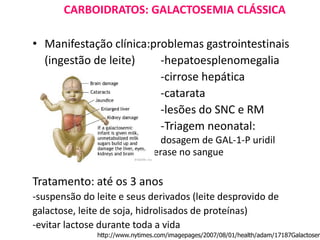 CARBOIDRATOS: GALACTOSEMIA CLÁSSICA
• Manifestação clínica:problemas gastrointestinais
(ingestão de leite) -hepatoesplenomegalia
-cirrose hepática
-catarata
-lesões do SNC e RM
-Triagem neonatal:
dosagem de GAL-1-P uridil
transferase no sangue
Tratamento: até os 3 anos
-suspensão do leite e seus derivados (leite desprovido de
galactose, leite de soja, hidrolisados de proteínas)
-evitar lactose durante toda a vida
http://www.nytimes.com/imagepages/2007/08/01/health/adam/17187Galactosem
 