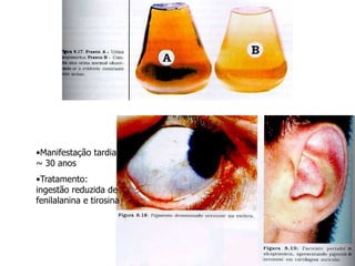 •Manifestação tardia:
~ 30 anos
•Tratamento:
ingestão reduzida de
fenilalanina e tirosina
 