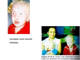 •Acuidade visual reduzida
•fotofobia
 