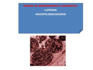 DOENÇA DE ARMAZENAMENTO LISOSSÔMICO
•LIPÍDEOS
•MUCOPOLISSACARÍDEOS
 