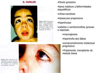 •Fácies grosseira
•baixa estatura c/deformidades
esqueléticas
•cifose-escoliose
•hipoacusia progressiva
•hipertricose
•cabelos e sombrancelhas grossas
e espessas
•macroglossia
•hipertrofia dos lábios
•comprometimento intelectual
progressivo
•Tratamento: transplante de
medula óssea
S. HURLER
 