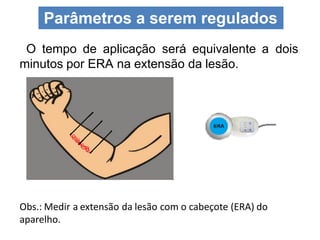 O tempo de aplicação será equivalente a dois
minutos por ERA na extensão da lesão.
Parâmetros a serem regulados
Obs.: Medir a extensão da lesão com o cabeçote (ERA) do
aparelho.
 