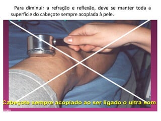 Para diminuir a refração e reflexão, deve se manter toda a
superfície do cabeçote sempre acoplada à pele.
 