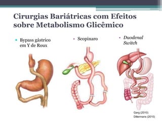 Cirurgias Bariátricas com Efeitos 
sobre Metabolismo Glicêmico 
• Scopinaro • Duodenal 
Switch 
Garg (2010) 
Dillermans (2010) 
 Bypass gástrico 
em Y de Roux 
 