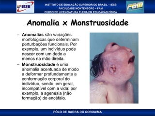 Anomalia x Monstruosidade Anomalias  são variações morfológicas que determinam perturbações funcionais. Por exemplo, um indivíduo pode nascer com um dedo a menos na mão direita. Monstruosidade  é uma anomalia acentuada de modo a deformar profundamente a conformação corporal do indivíduo, sendo, em geral, incompatível com a vida: por exemplo, a agenesia (não formação) do encéfalo. PÓLO DE BARRA DO CORDA/MA 