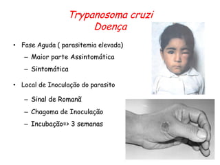 Trypanosoma cruzi
Doença
• Fase Aguda ( parasitemia elevada)
– Maior parte Assintomática
– Sintomática
• Local de Inoculação do parasito
– Sinal de Romanã
– Chagoma de Inoculação
– Incubação=> 3 semanas
 