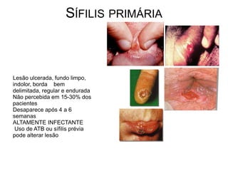 SÍFILIS PRIMÁRIA
Lesão ulcerada, fundo limpo,
indolor, borda bem
delimitada, regular e endurada
Não percebida em 15-30% dos
pacientes
Desaparece após 4 a 6
semanas
ALTAMENTE INFECTANTE
Uso de ATB ou sífilis prévia
pode alterar lesão
 