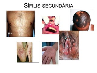 SÍFILIS SECUNDÁRIA
 