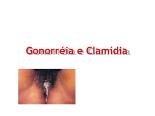 Gonorréia e Clamídia
 