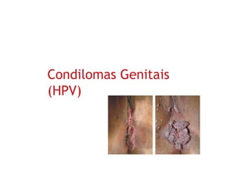 Condilomas Genitais
(HPV)
 