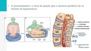 • O posicionamento e o local de punção para a anestesia peridural são os
mesmos da raquianestesia
 