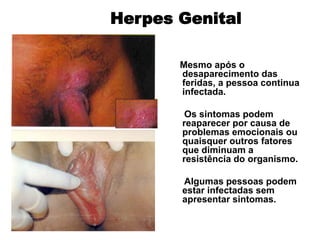 Mesmo após o
desaparecimento das
feridas, a pessoa continua
infectada.
Os sintomas podem
reaparecer por causa de
problemas emocionais ou
quaisquer outros fatores
que diminuam a
resistência do organismo.
Algumas pessoas podem
estar infectadas sem
apresentar sintomas.
Herpes Genital
 
