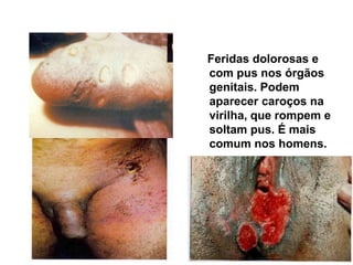 Feridas dolorosas e
com pus nos órgãos
genitais. Podem
aparecer caroços na
virilha, que rompem e
soltam pus. É mais
comum nos homens.
Cancro Mole
 
