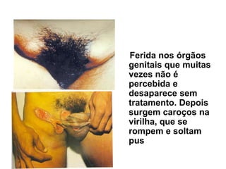 Ferida nos órgãos
genitais que muitas
vezes não é
percebida e
desaparece sem
tratamento. Depois
surgem caroços na
virilha, que se
rompem e soltam
pus
Linfogranuloma Venéreo
 