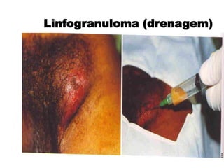 Linfogranuloma (drenagem)
 
