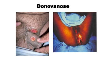 Começa com caroço, em seguida forma uma ferida que
cresce em volume e extensão. Não dói e não tem íngua.
Donovanose
 