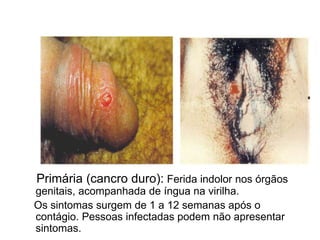 Primária (cancro duro): Ferida indolor nos órgãos
genitais, acompanhada de íngua na virilha.
Os sintomas surgem de 1 a 12 semanas após o
contágio. Pessoas infectadas podem não apresentar
sintomas.
Sífilis
 