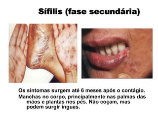 Os sintomas surgem até 6 meses após o contágio.
Manchas no corpo, principalmente nas palmas das
mãos e plantas nos pés. Não coçam, mas
podem surgir ínguas.
Sífilis (fase secundária)
 