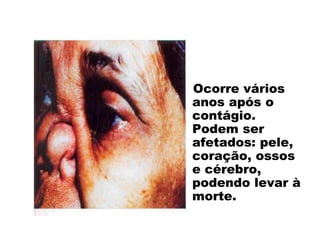 Ocorre vários
anos após o
contágio.
Podem ser
afetados: pele,
coração, ossos
e cérebro,
podendo levar à
morte.
Sífilis (fase terciária)
 