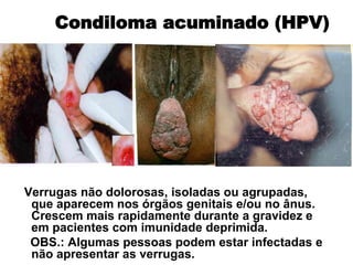 Verrugas não dolorosas, isoladas ou agrupadas,
que aparecem nos órgãos genitais e/ou no ânus.
Crescem mais rapidamente durante a gravidez e
em pacientes com imunidade deprimida.
OBS.: Algumas pessoas podem estar infectadas e
não apresentar as verrugas.
Condiloma acuminado (HPV)
 