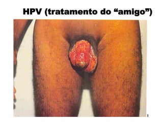 HPV (tratamento do “amigo”)
 