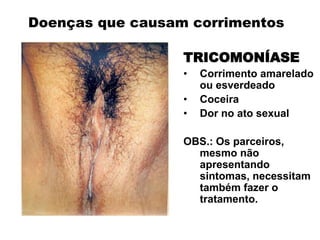 TRICOMONÍASE
• Corrimento amarelado
ou esverdeado
• Coceira
• Dor no ato sexual
OBS.: Os parceiros,
mesmo não
apresentando
sintomas, necessitam
também fazer o
tratamento.
Doenças que causam corrimentos
 