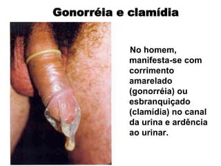 No homem,
manifesta-se com
corrimento
amarelado
(gonorréia) ou
esbranquiçado
(clamídia) no canal
da urina e ardência
ao urinar.
Gonorréia e clamídia
 
