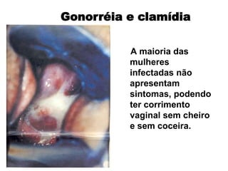 A maioria das
mulheres
infectadas não
apresentam
sintomas, podendo
ter corrimento
vaginal sem cheiro
e sem coceira.
Gonorréia e clamídia
 