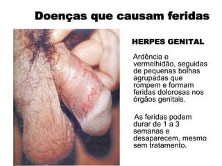 HERPES GENITAL
Ardência e
vermelhidão, seguidas
de pequenas bolhas
agrupadas que
rompem e formam
feridas dolorosas nos
órgãos genitais.
As feridas podem
durar de 1 a 3
semanas e
desaparecem, mesmo
sem tratamento.
Doenças que causam feridas
 