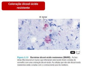 Coloração álcool-ácido
resistente
 