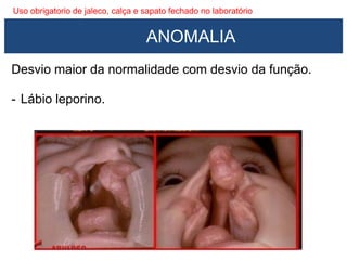 Uso obrigatorio de jaleco, calça e sapato fechado no laboratório
Desvio maior da normalidade com desvio da função.
- Lábio leporino.
ANOMALIA
 