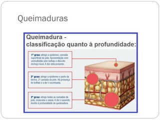 Queimaduras
 