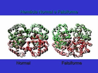 Hemácia Normal e FalsiformeHemácia Normal e Falsiforme
NormalNormal FalsiformeFalsiforme
 